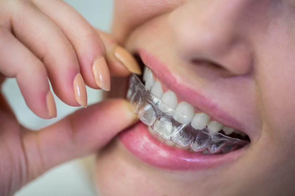 Invisalign Bellevue, WA